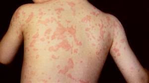 Autoinflammatory Disorders