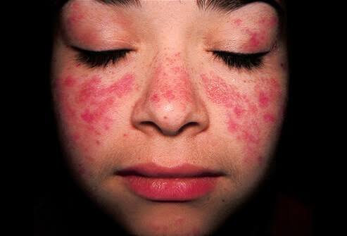 Childhood Lupus