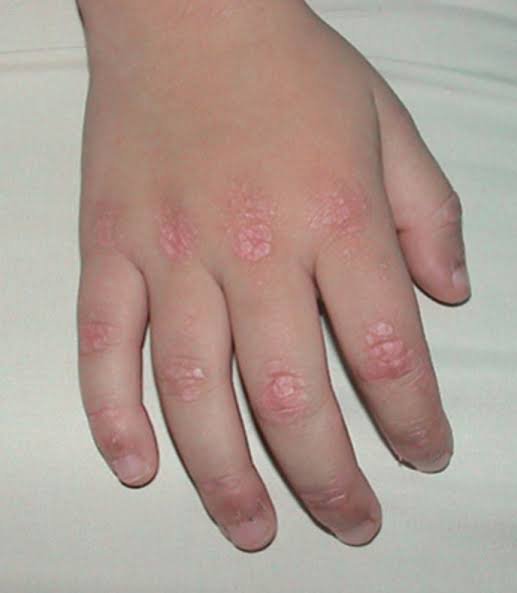 Childhood Scleroderma