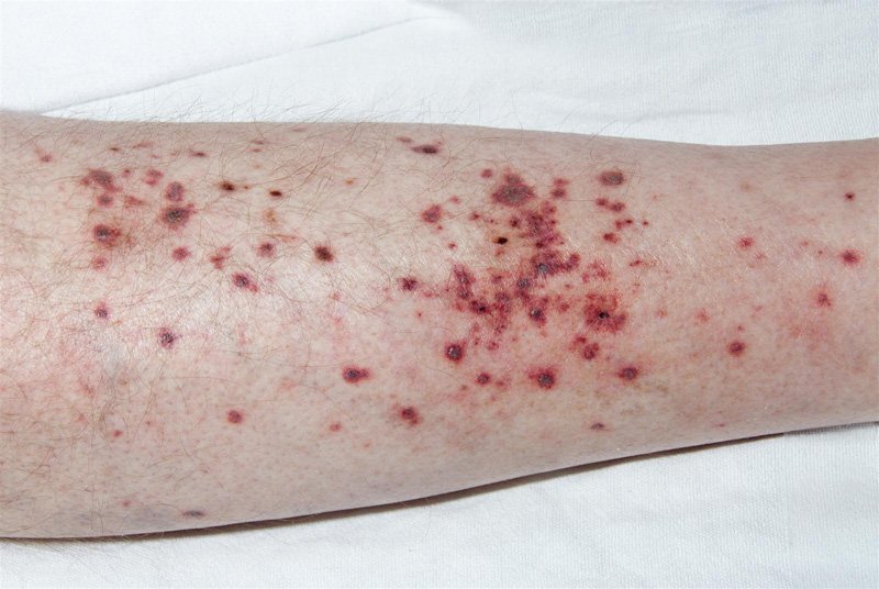 Pediatric Vasculitis